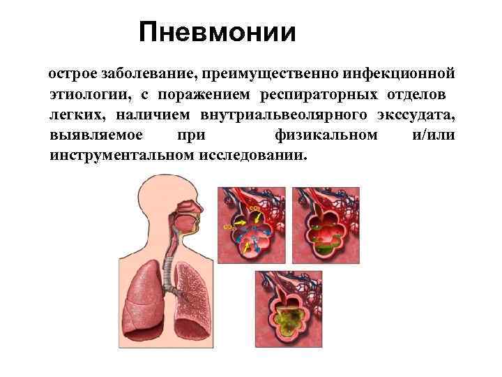 Пневмонии острое заболевание, преимущественно инфекционной этиологии, с поражением респираторных отделов легких, наличием внутриальвеолярного экссудата,