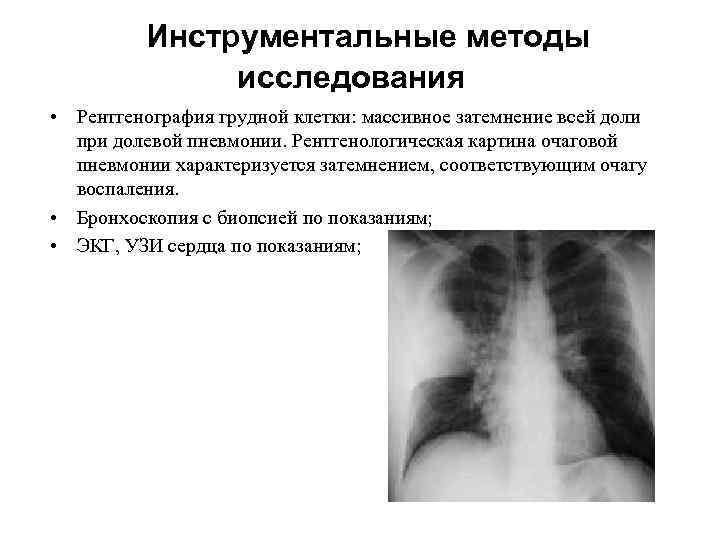 Инструментальные методы исследования • Рентгенография грудной клетки: массивное затемнение всей доли при долевой пневмонии.