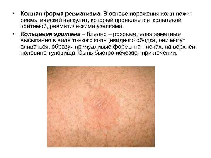  • Кожная форма ревматизма. В основе поражения кожи лежит ревматический васкулит, который проявляется