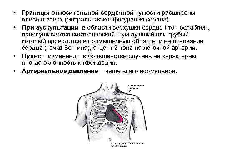  • Границы относительной сердечной тупости расширены влево и вверх (митральная конфигурация сердца). •