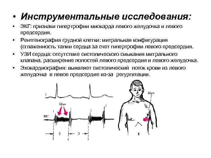 Самый частый экг признак внезапной смерти