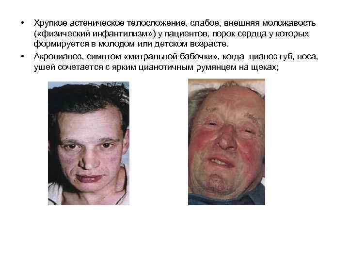  • • Хрупкое астеническое телосложение, слабое, внешняя моложавость ( «физический инфантилизм» ) у