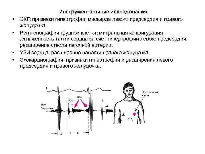  • • Инструментальные исследования: ЭКГ: признаки гипертрофии миокарда левого предсердия и правого желудочка.