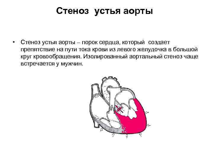 Стеноз устья аорты • Стеноз устья аорты – порок сердца, который создает препятствие на