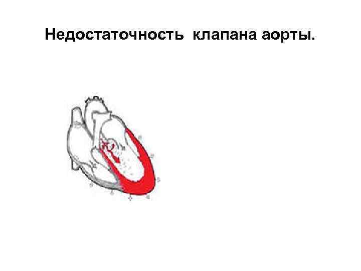 Недостаточность клапана аорты. 