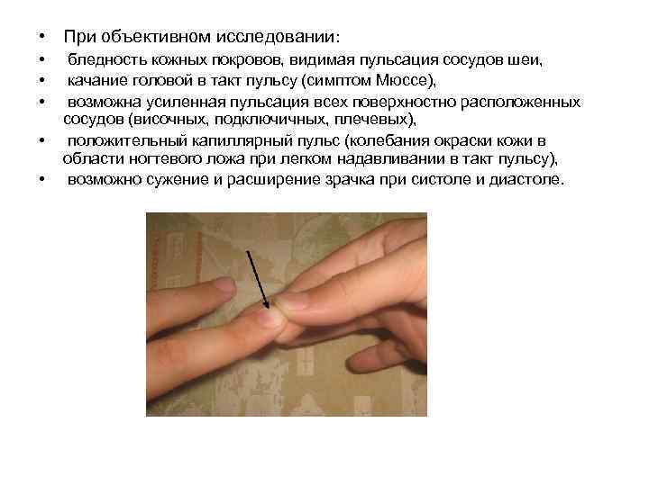  • При объективном исследовании: • • • бледность кожных покровов, видимая пульсация сосудов