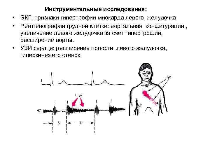 Инструментальные исследования: • ЭКГ: признаки гипертрофии миокарда левого желудочка. • Рентгенография грудной клетки: аортальная