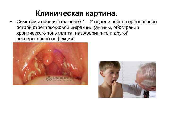 Клиническая картина. • Симптомы появляются через 1 – 2 недели после перенесенной острой стрептококковой