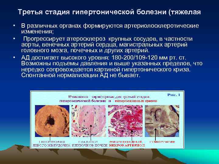 Третья стадия гипертонической болезни (тяжелая • В различных органах формируются артериолосклеротические изменения; • Пporpecсирует