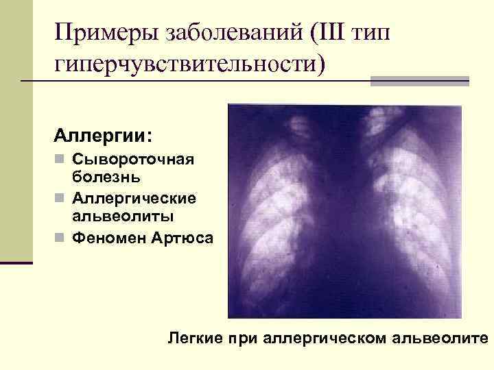 Примеры заболеваний (III тип гиперчувствительности) Аллергии: n Сывороточная болезнь n Аллергические альвеолиты n Феномен