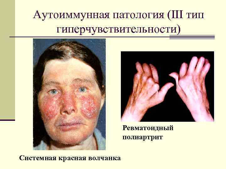 Аутоиммунная патология (III тип гиперчувствительности) Ревматоидный полиартрит Системная красная волчанка 