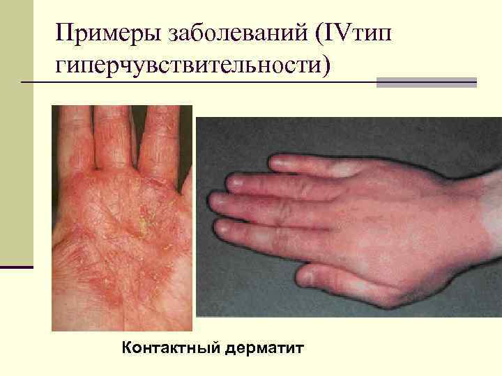 Примеры заболеваний (IVтип гиперчувствительности) Контактный дерматит 