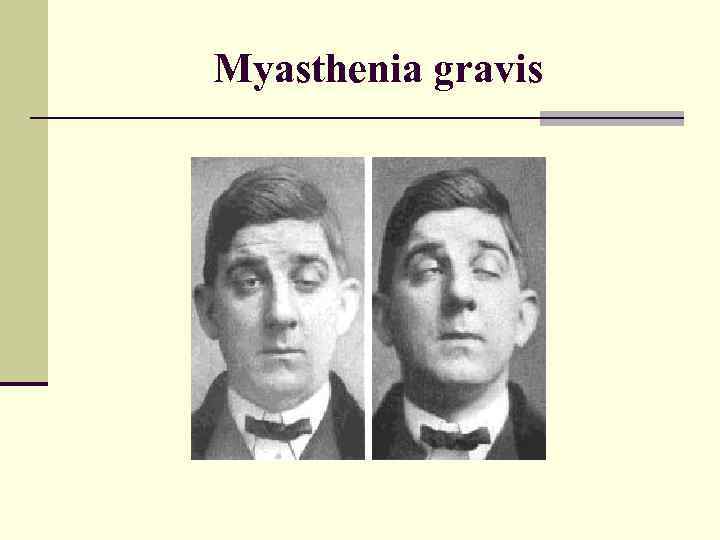 Myasthenia gravis 