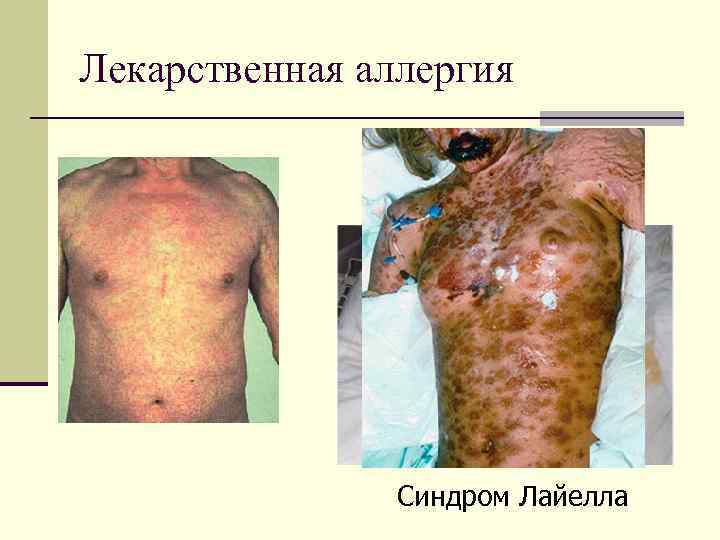 Лекарственная аллергия Синдром Лайелла 