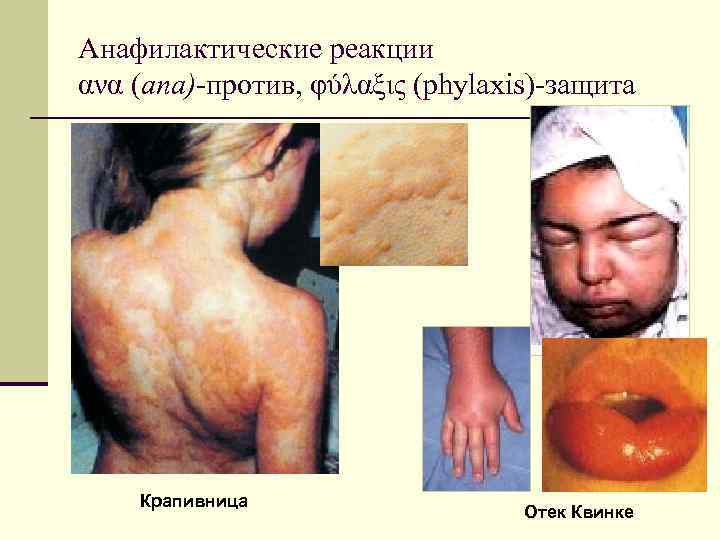 Анафилактические реакции ανα (ana)-против, φύλαξις (phylaxis)-защита Крапивница Отек Квинке 