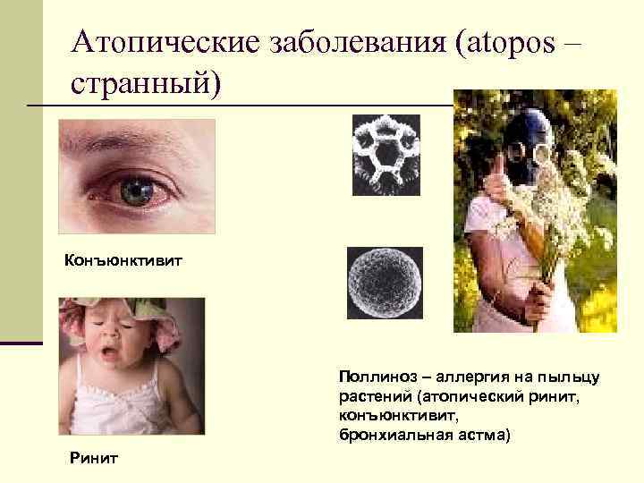 Атопические заболевания (atopos – странный) Конъюнктивит Поллиноз – аллергия на пыльцу растений (атопический ринит,