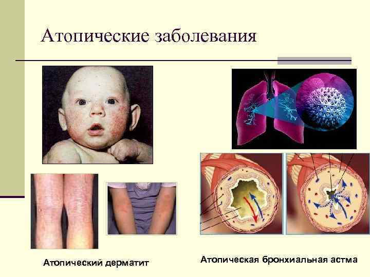 Атопические заболевания Атопический дерматит Атопическая бронхиальная астма 