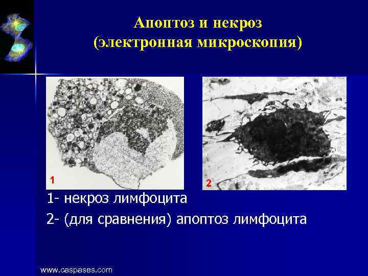 Апоптоз и некроз (электронная микроскопия) 1 2 1 - некроз лимфоцита 2 - (для