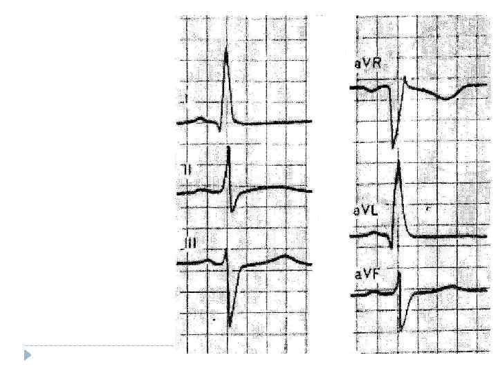 а) R І > R ІІІ S ІІ > R ІІІ б) глубокий зубец