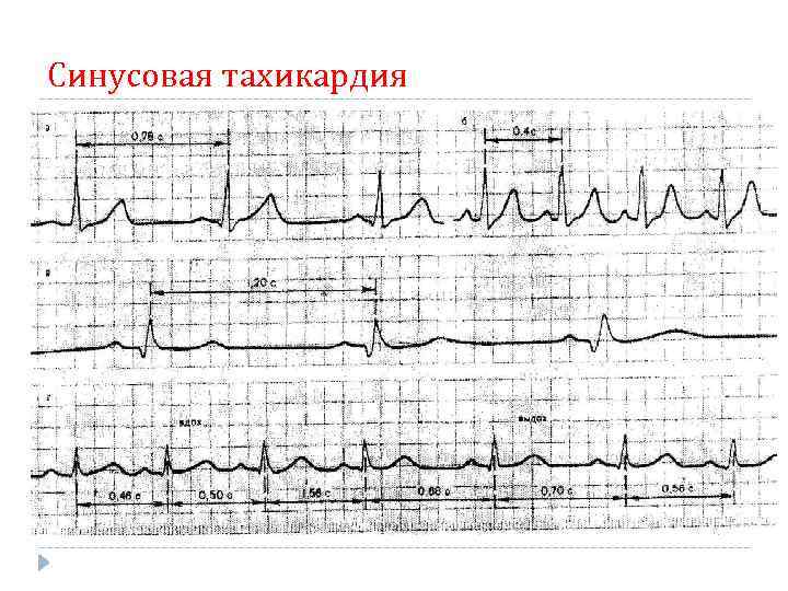 Синусовая тахикардия 