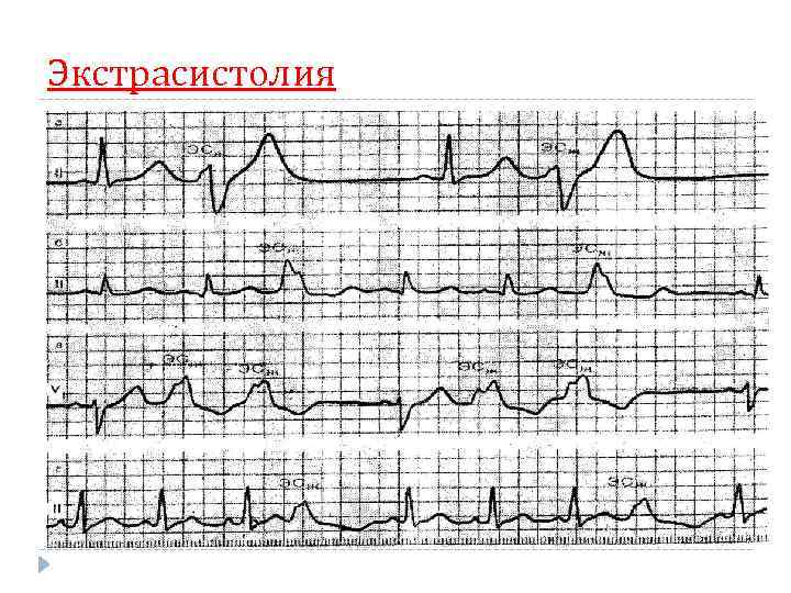 Экстрасистолия 
