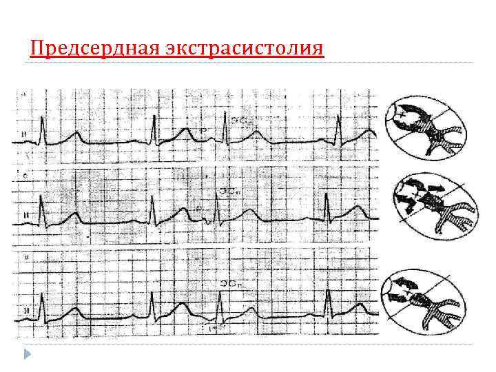 Предсердная экстрасистолия 