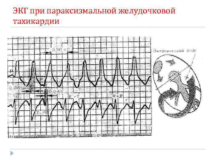 ЭКГ при параксизмальной желудочковой тахикардии 