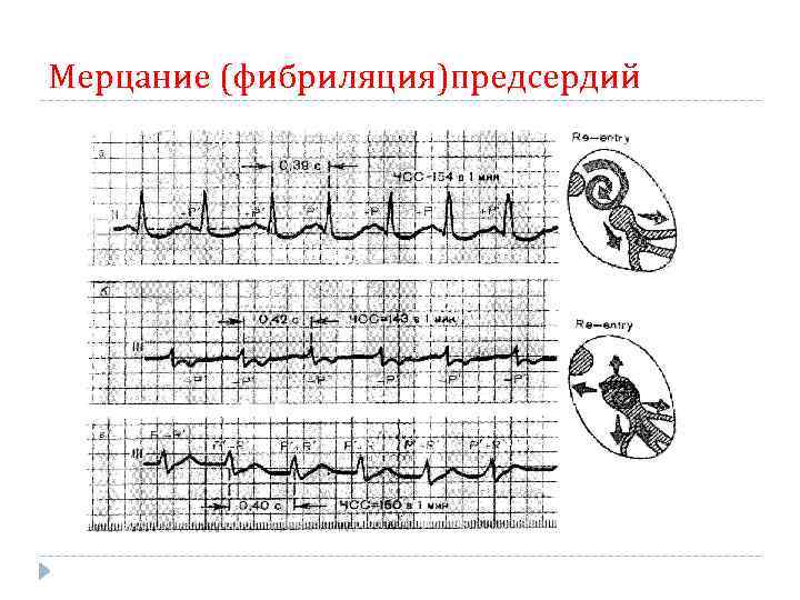 Мерцание (фибриляция)предсердий 