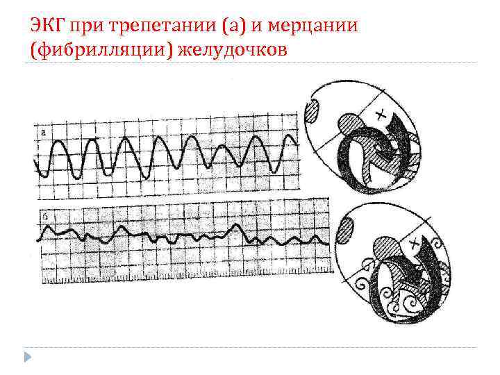 ЭКГ при трепетании (а) и мерцании (фибрилляции) желудочков 