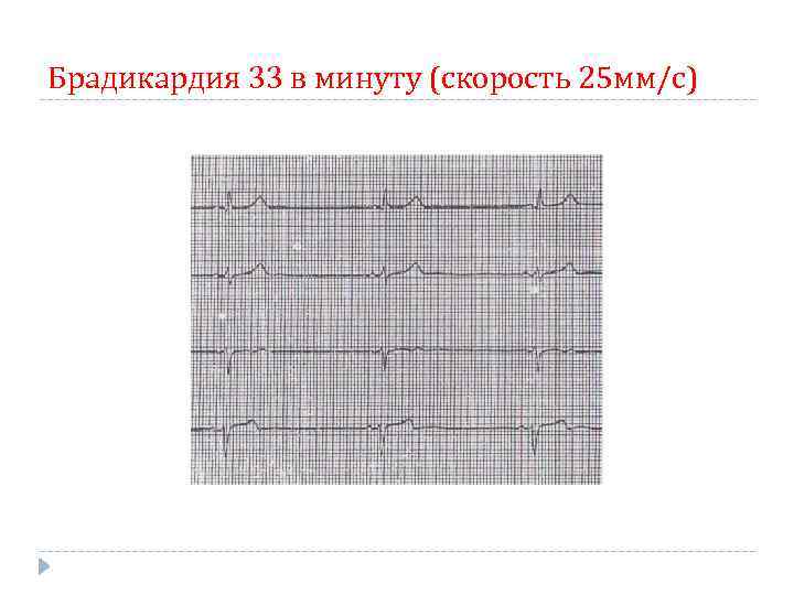 Брадикардия 33 в минуту (скорость 25 мм/с) 