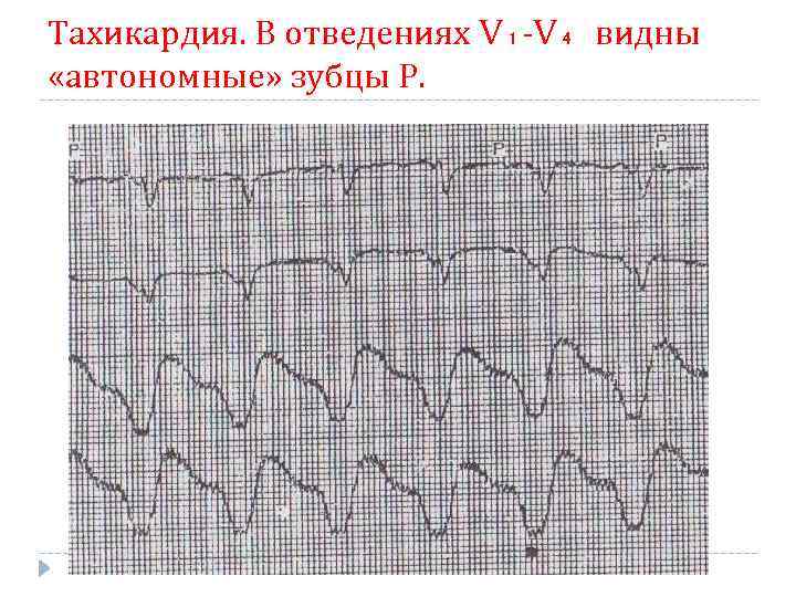 Тахикардия. В отведениях V₁-V₄ видны «автономные» зубцы Р. 