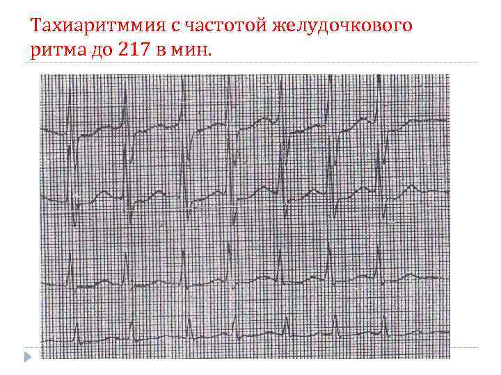 Тахиаритммия с частотой желудочкового ритма до 217 в мин. 