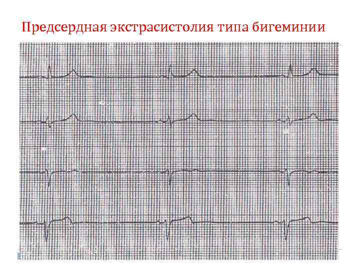 Нарушение ритма по типу бигеминии карта вызова