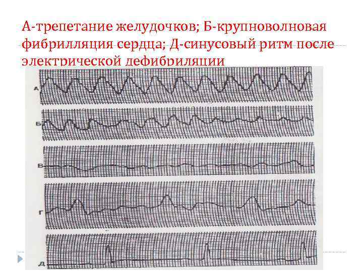 А-трепетание желудочков; Б-крупноволновая фибрилляция сердца; Д-синусовый ритм после электрической дефибриляции 