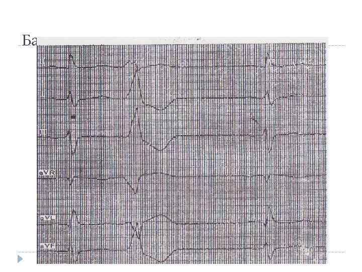 Базальные желудочковые экстрасистолы 
