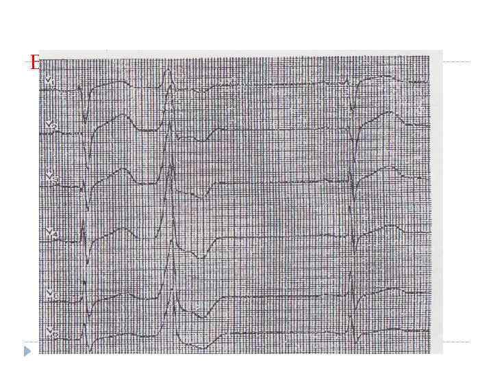 Базальные желудочковые экстрасистолы 