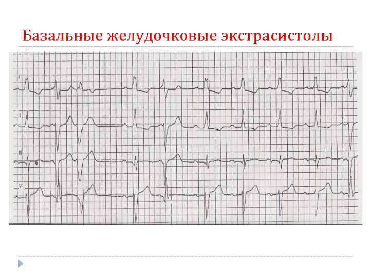 Частые желудочковые экстрасистолы карта вызова