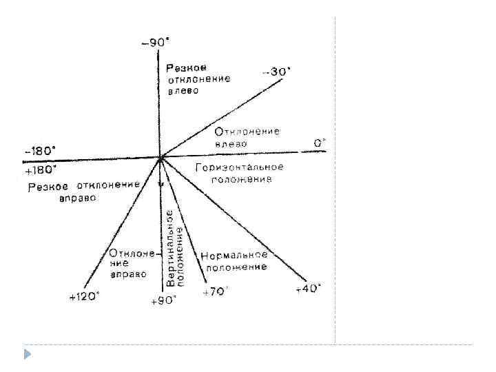 Общее соотношение зубцов, характерное для отклонения электрической оси сердца с углом +70 до+180, будет