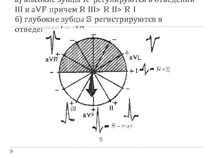а) высокие зубцы R регулируются в отведении ІІІ и а. VF причем R ІІІ>
