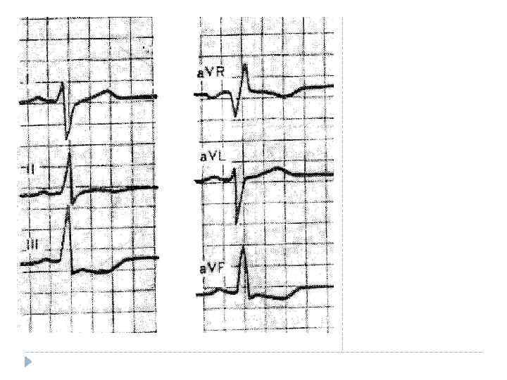 Для нормального положения электрической оси сердца угол от +40 до +70 характерно следующее соотношение