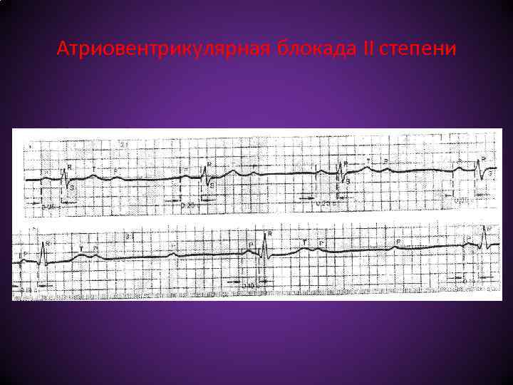 Атриовентрикулярная блокада II степени 