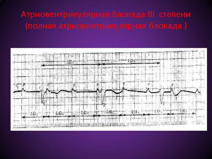 Атриовентрикулярная блокада III степени (полная атриовентрикулярная блокада ) 