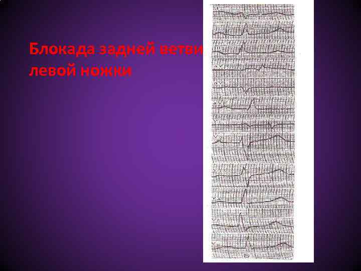 Блокада задней ветви левой ножки 