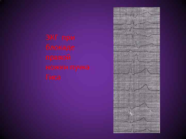 ЭКГ при блокаде правой ножки пучка Гиса 
