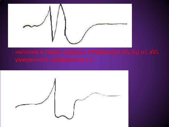 - наличие в левых грудных отведениях (V₅, V₆) и. I, а. VL умеренного зазубренного
