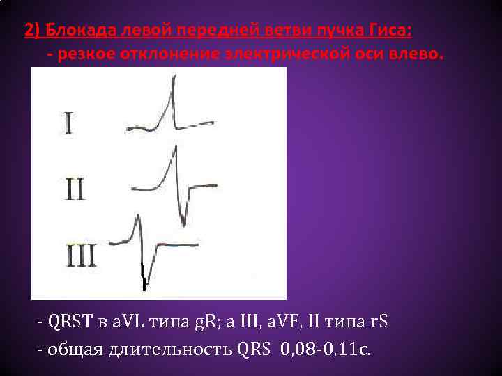 2) Блокада левой передней ветви пучка Гиса: - резкое отклонение электрической оси влево. -