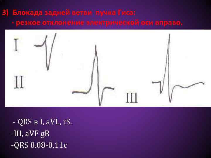 3) Блокада задней ветви пучка Гиса: - резкое отклонение электрической оси вправо. - QRS