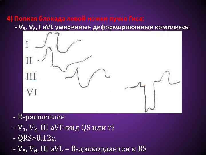 4) Полная блокада левой ножки пучка Гиса: - V₅, V₆, I а. VL умеренные