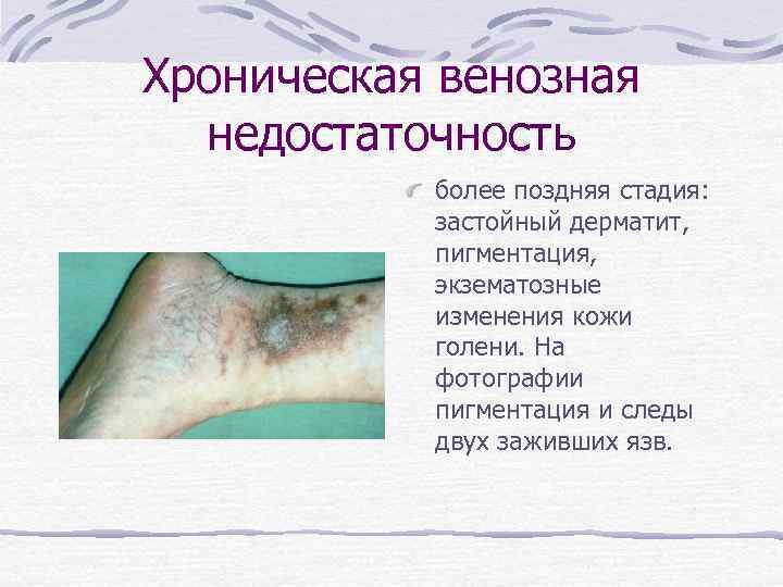 Хроническая венозная недостаточность более поздняя стадия: застойный дерматит, пигментация, экзематозные изменения кожи голени. На