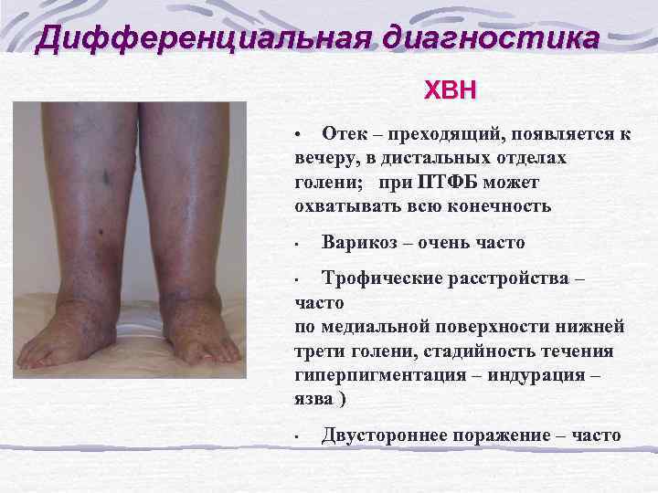 Дифференциальная диагностика ХВН Отек – преходящий, появляется к вечеру, в дистальных отделах голени; при